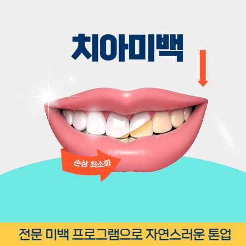성남치과 성남시 치과 치아미백